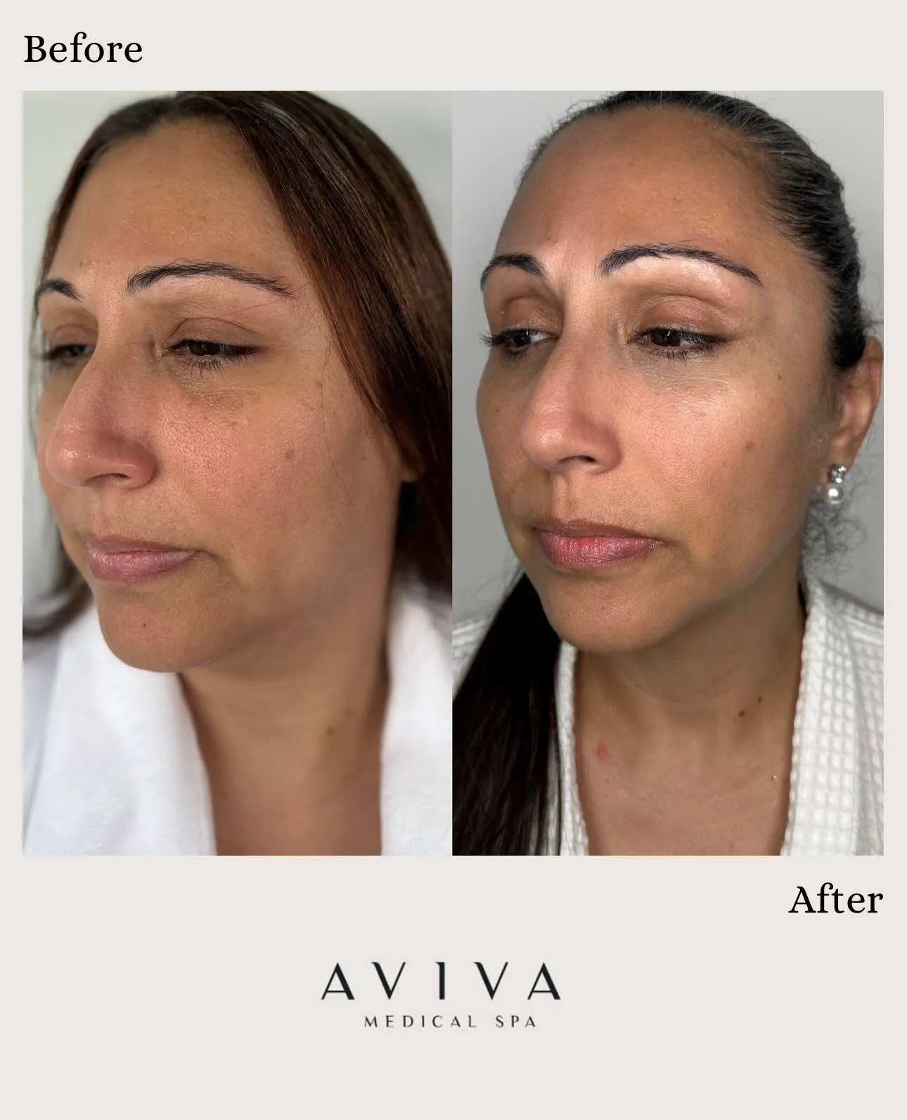 Morpheus8 Before & After